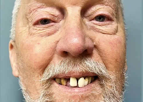Jim smiling with missing and worn teeth before full-arch dental implants
